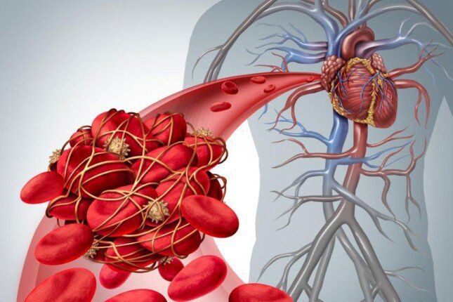 دراسة علمية كندية تتوصل إلى آلية اضطراب تؤدي لجلطات دموية خطيرة